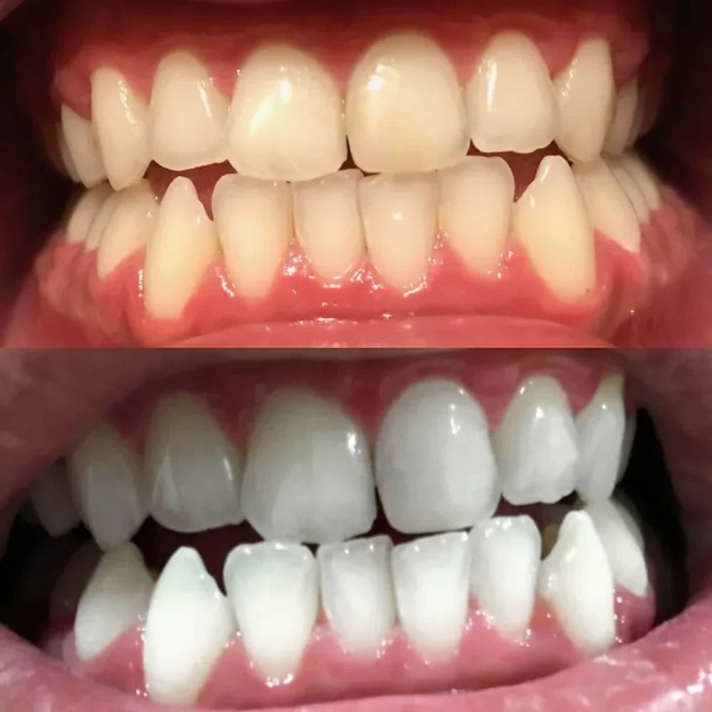 Teeth Whitening White Strips