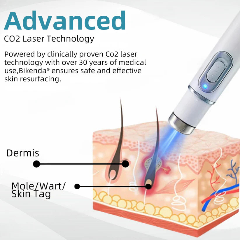 Molde® Promax Laser Pen – Non-Invasive Mole & Wart Removal