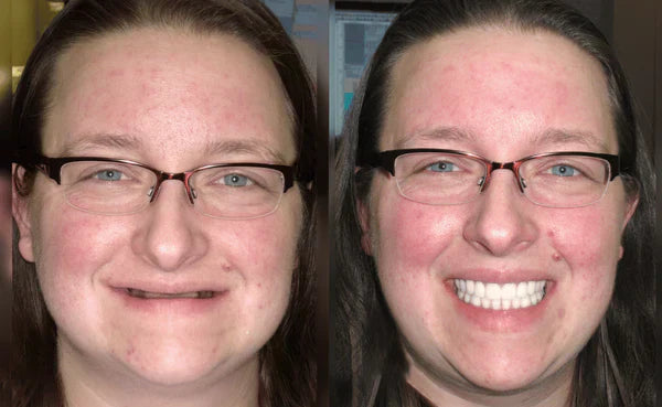 Comfort-Fit Flexible Dentures – Natural Look Easy Wear & Removal