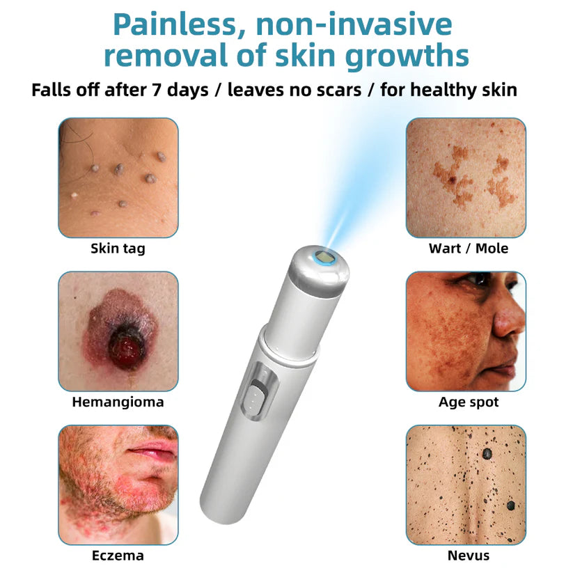 Molde® Promax Laser Pen – Non-Invasive Mole & Wart Removal