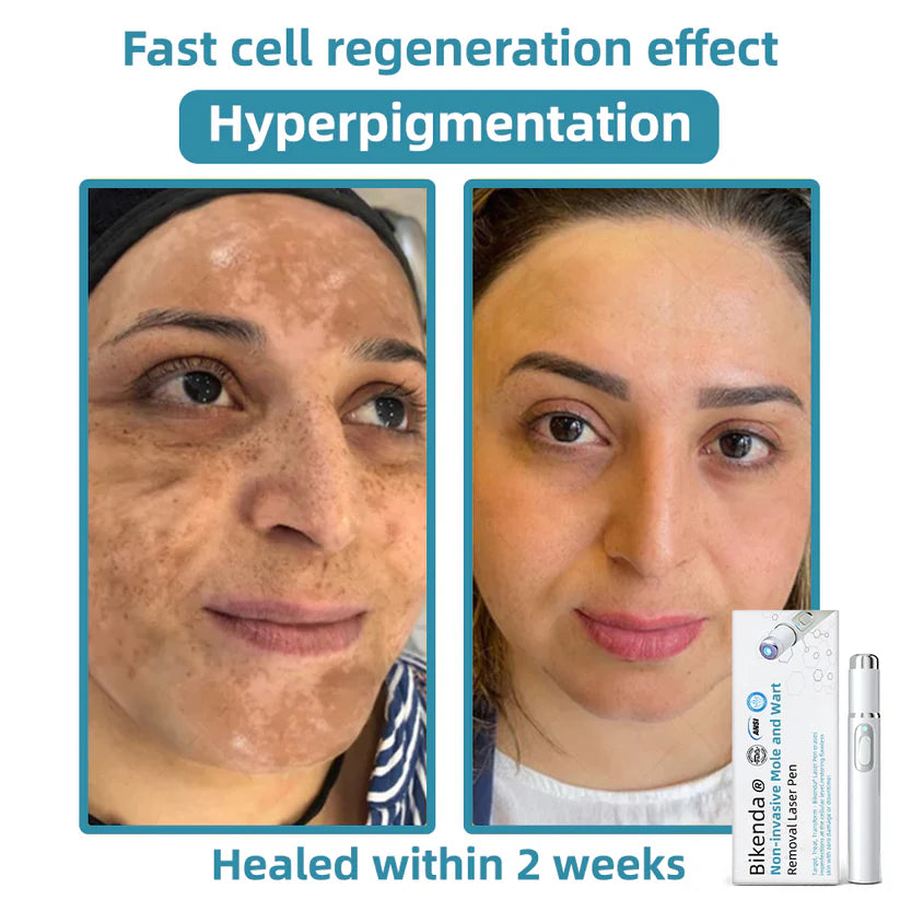 Molde® Promax Laser Pen – Non-Invasive Mole & Wart Removal