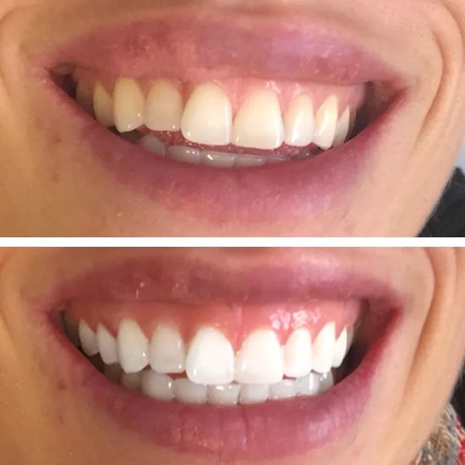 Teeth Whitening White Strips