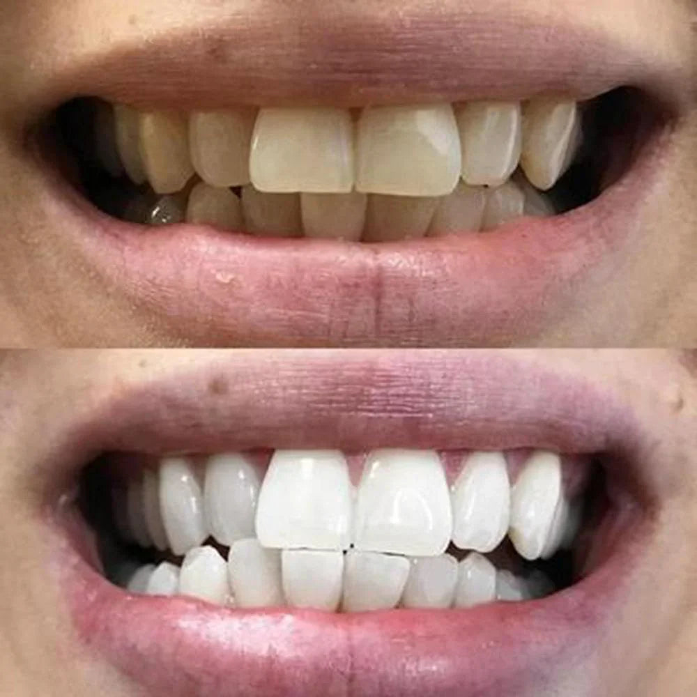 Teeth Whitening White Strips