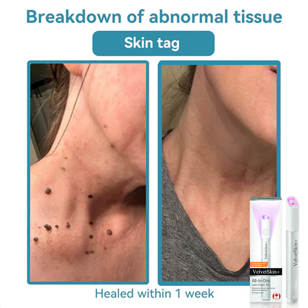 DermaBeam Pro – Erase Skin Flaws Instantly