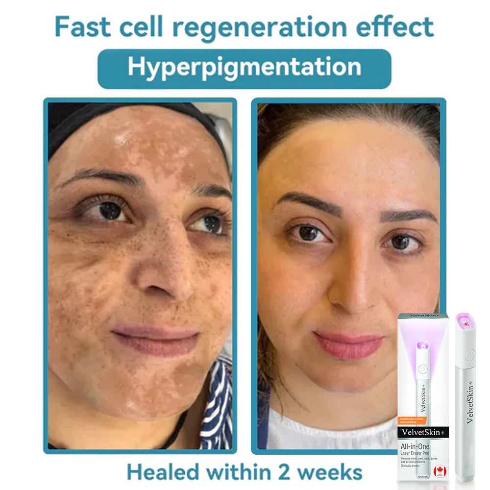 DermaBeam Pro – Erase Skin Flaws Instantly