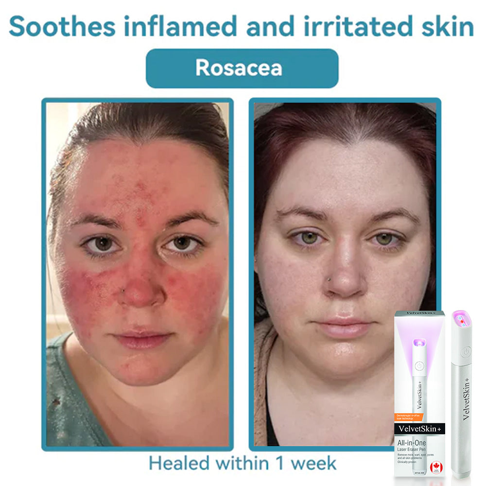 DermaBeam Pro – Erase Skin Flaws Instantly