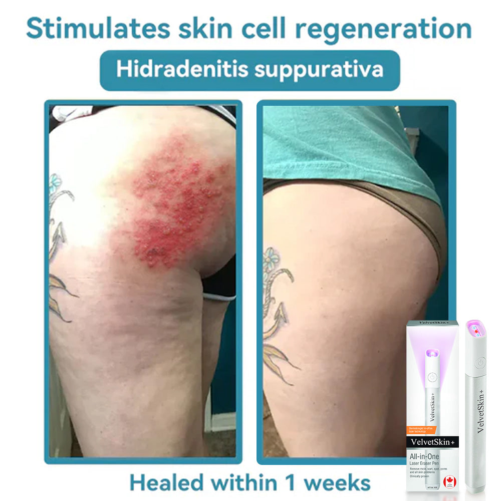 DermaBeam Pro – Erase Skin Flaws Instantly