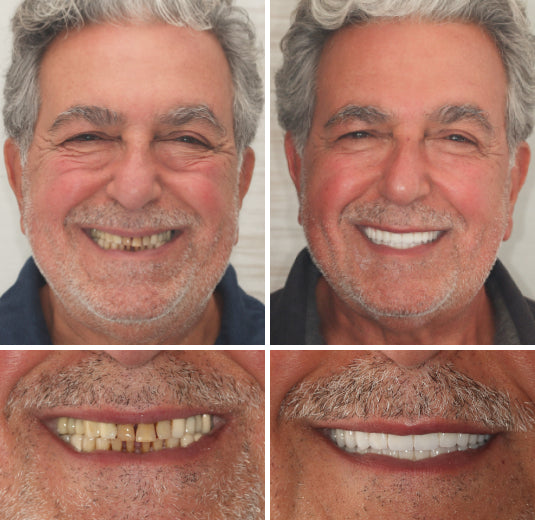 Comfort-Fit Flexible Dentures – Natural Look Easy Wear & Removal